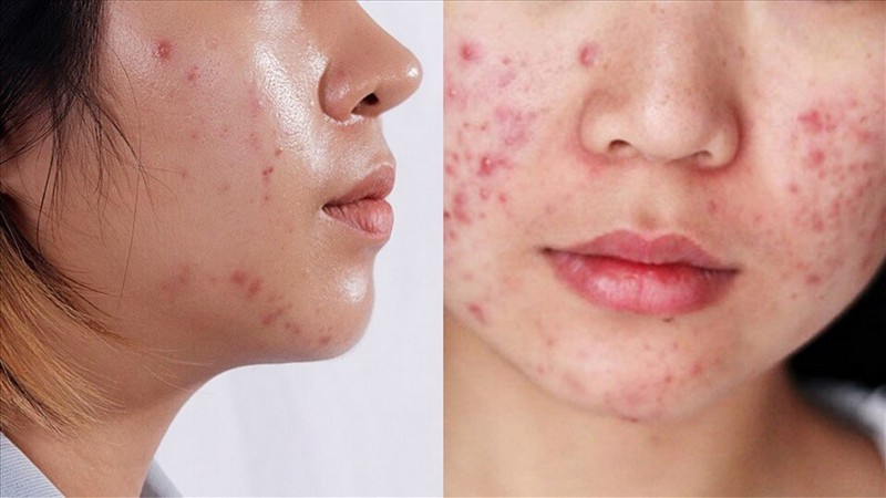 Skincare xong da bị đổ dầu cũng là một trong những tác nhân gây mụn