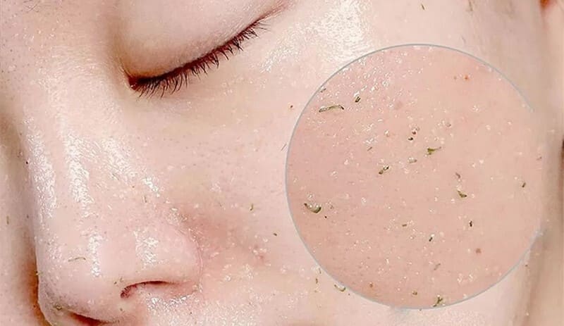 Tẩy tế bào chết cho da mặt - Bước không thể thiếu khi chăm da dầu mụn tại nhà