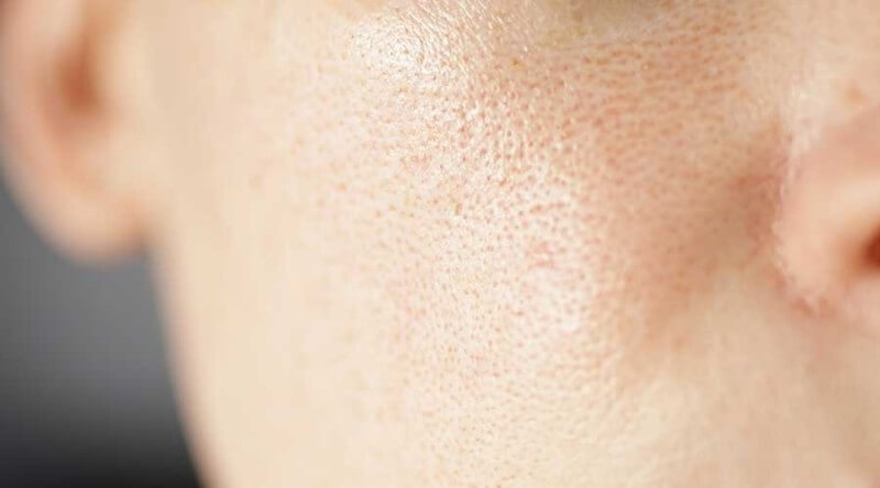 Nguyên nhân khiến lỗ chân lông của làn da bị giãn nở